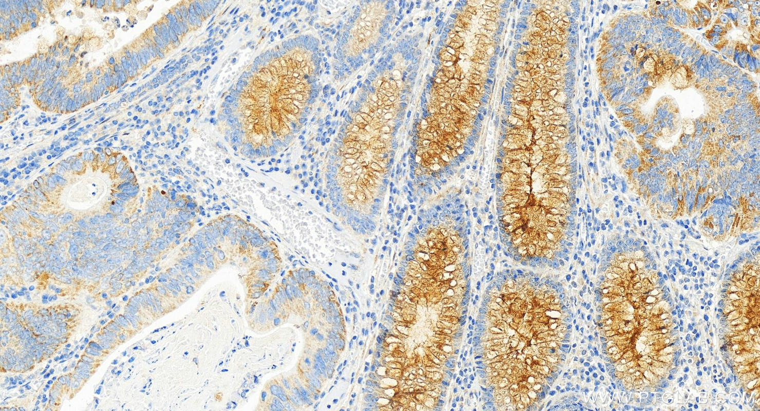 IHC staining of human colon cancer using 83709-1-RR