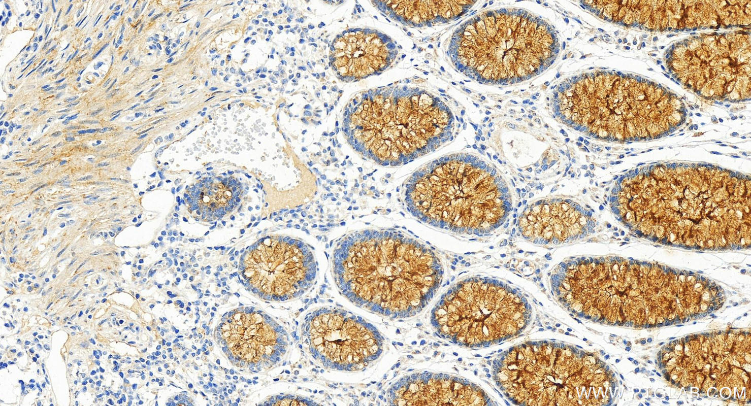 IHC staining of human colon cancer using 83709-1-RR (same clone as 83709-1-PBS)