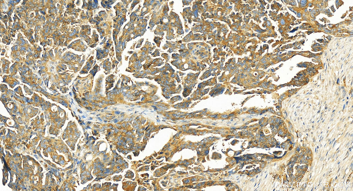 IHC staining of human ovary cancer using 19564-1-AP