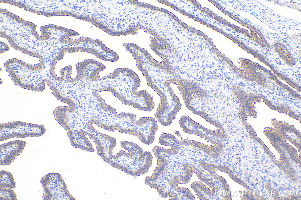 IHC staining of human ovary tumor using 23301-1-AP