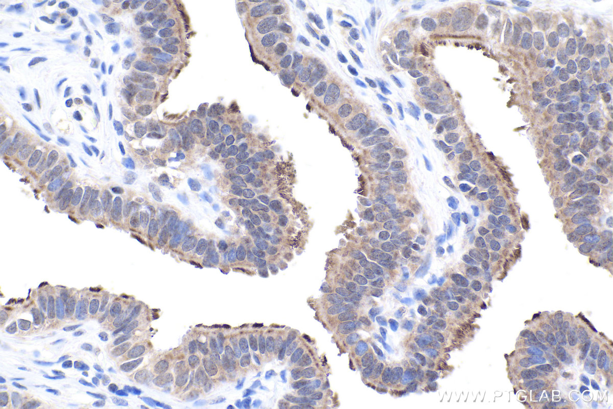 IHC staining of human ovary tumor using 23301-1-AP