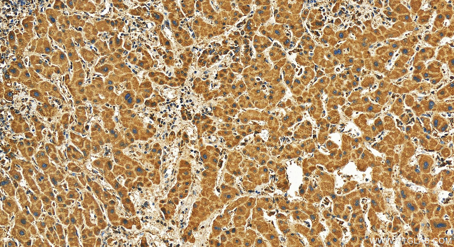 IHC staining of human intrahepatic cholangiocarcinoma using 28114-1-AP