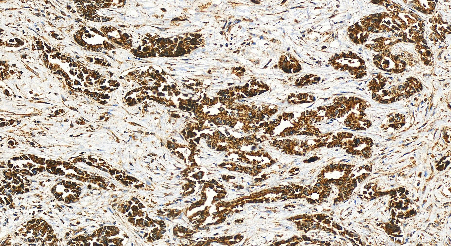 IHC staining of human intrahepatic cholangiocarcinoma using 28114-1-AP