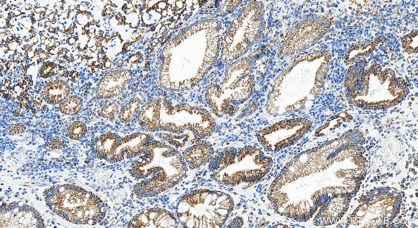 IHC staining of human stomach cancer using 83671-2-RR (same clone as 83671-2-PBS)