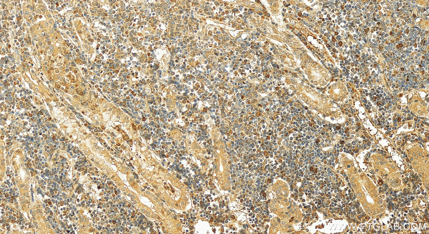 IHC staining of human stomach cancer using 11998-1-AP