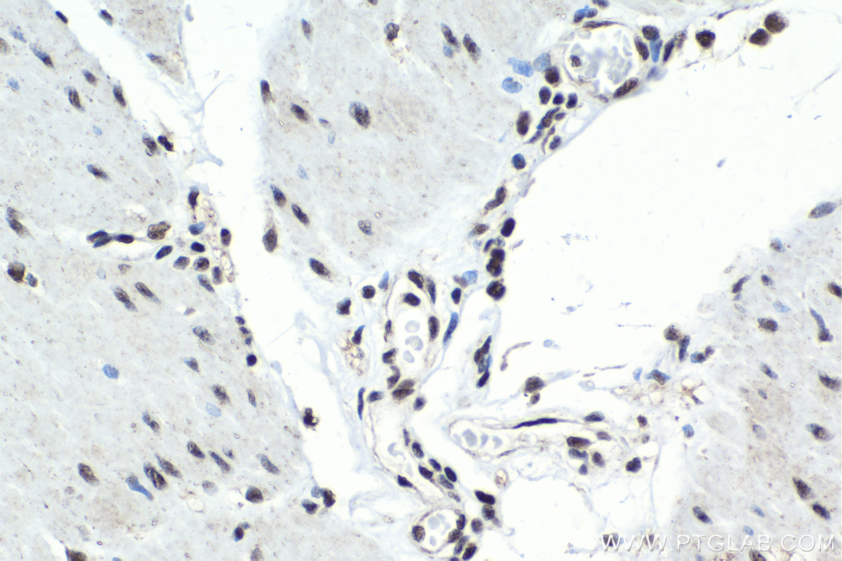 IHC staining of human stomach cancer using 22327-1-AP