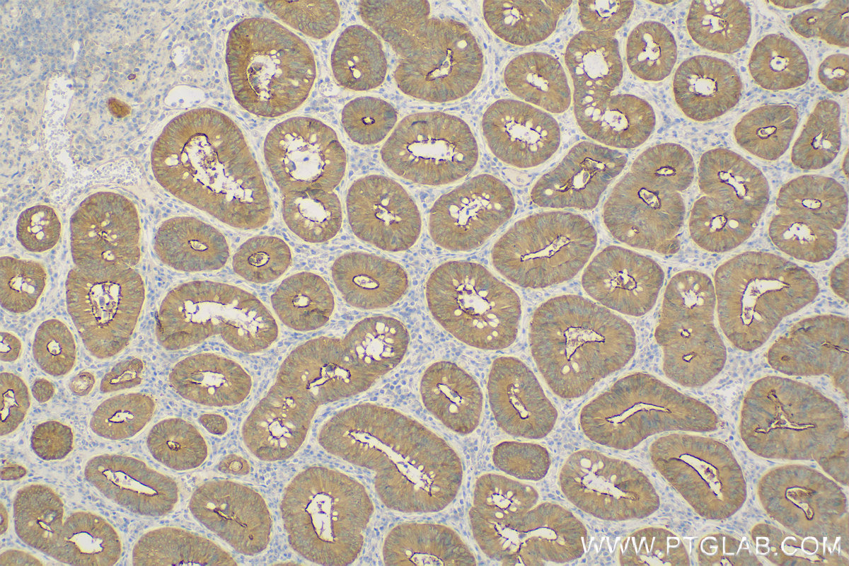 IHC staining of Human Colon cancer using 11358-1-AP