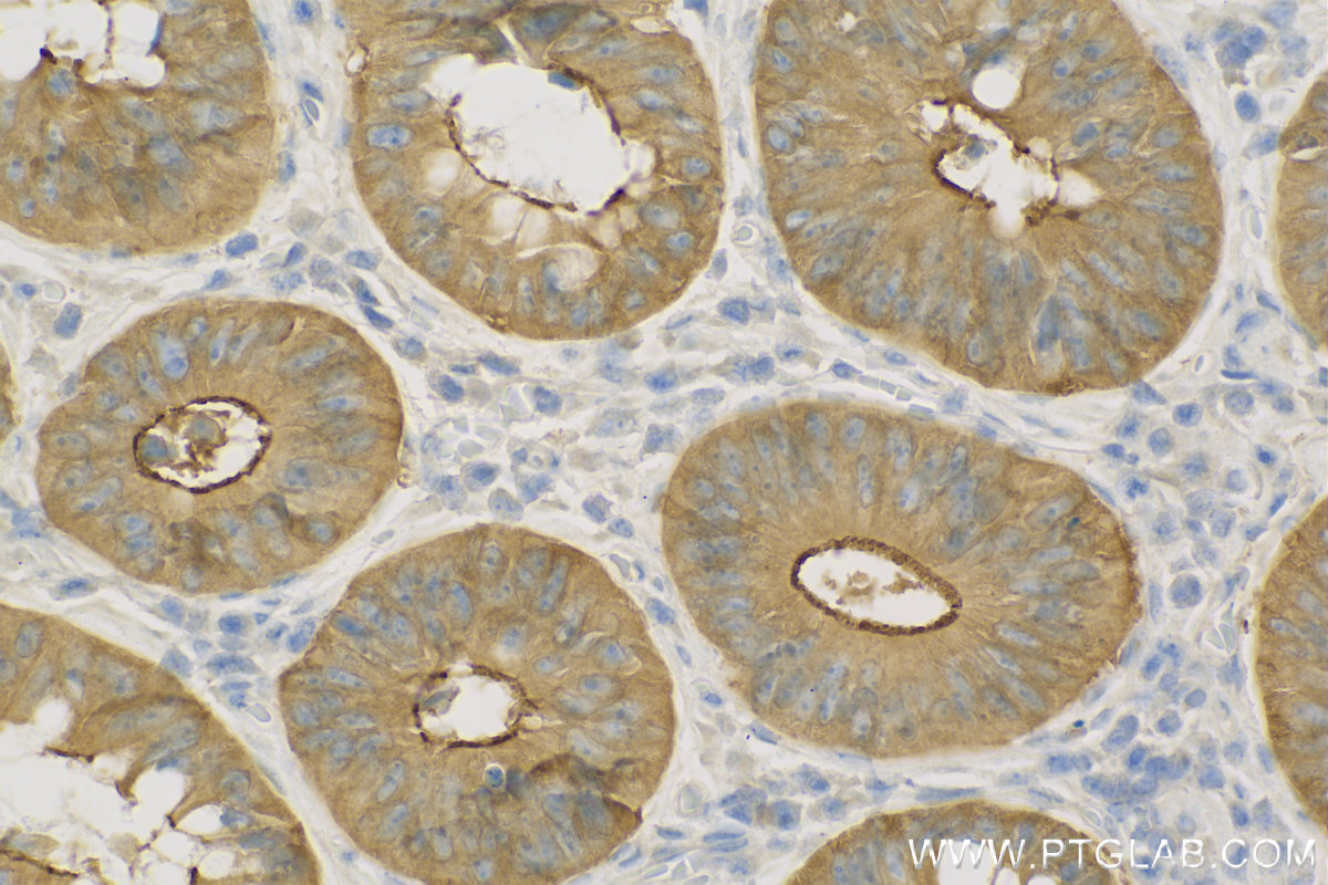 IHC staining of Human Colon cancer using 11358-1-AP