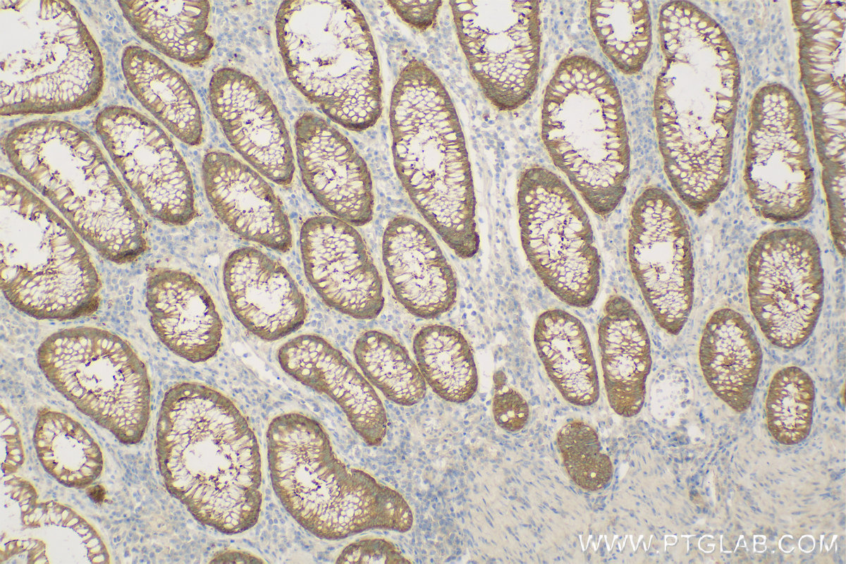 IHC staining of Human Colon cancer using 11358-1-AP