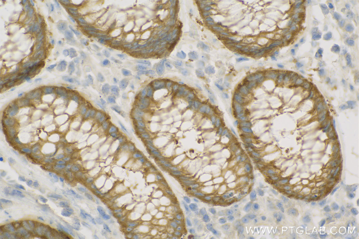 IHC staining of Human Colon cancer using 11358-1-AP