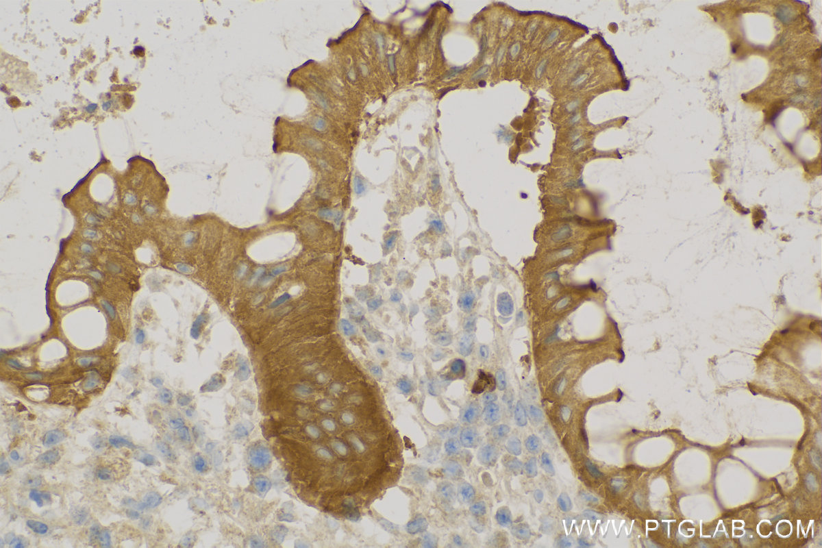 IHC staining of Human Colon cancer using 11358-1-AP