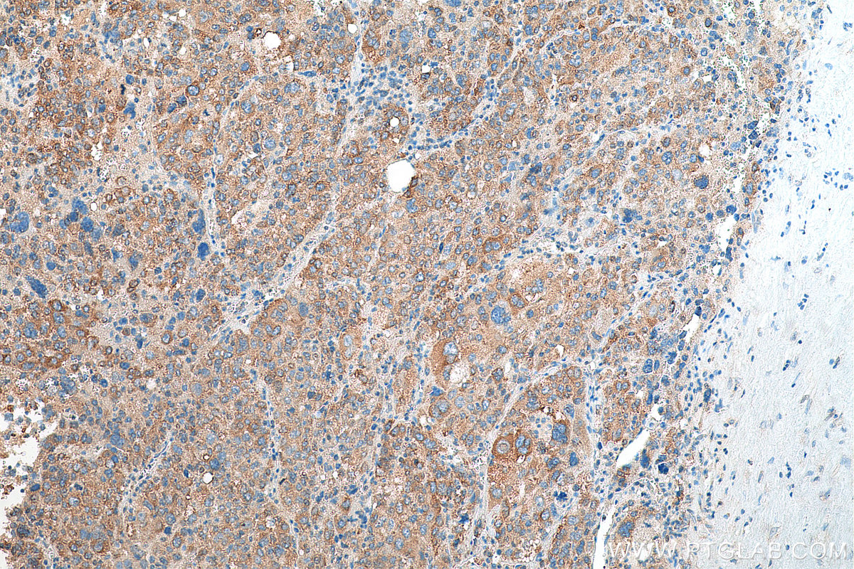 IHC staining of human liver cancer using 67917-1-Ig (same clone as 67917-1-PBS)