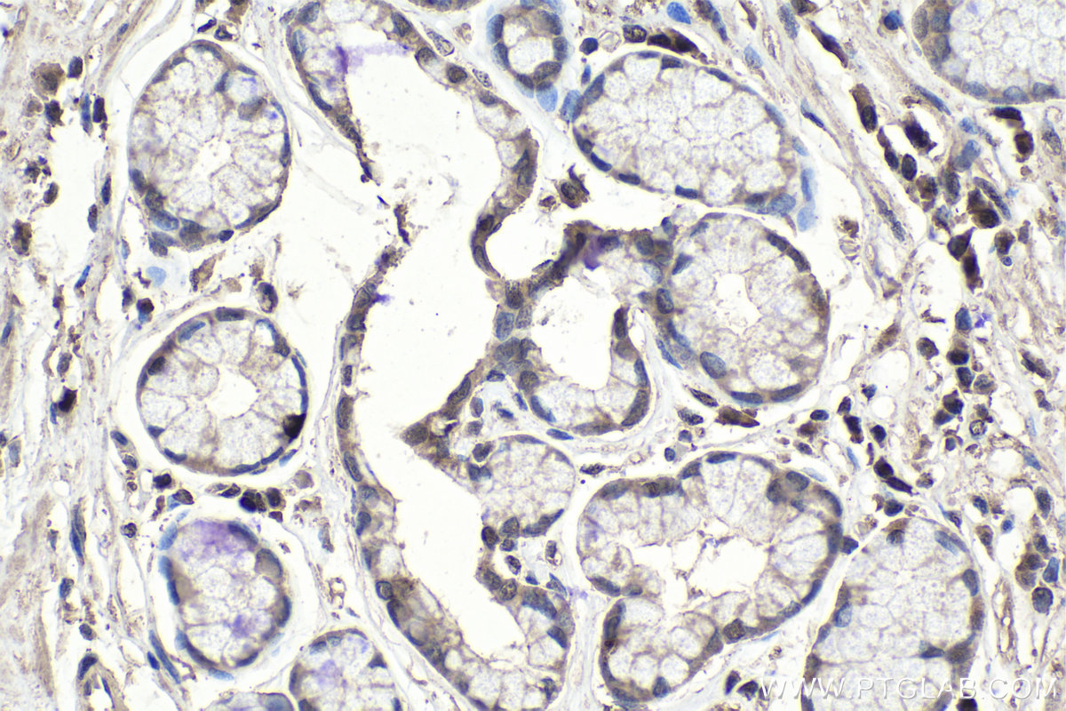 IHC staining of human stomach cancer using 67805-1-Ig