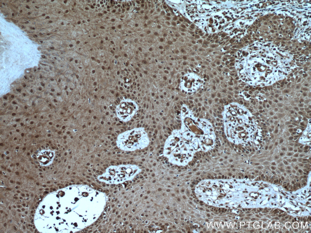 IHC staining of human skin cancer using 16840-1-AP