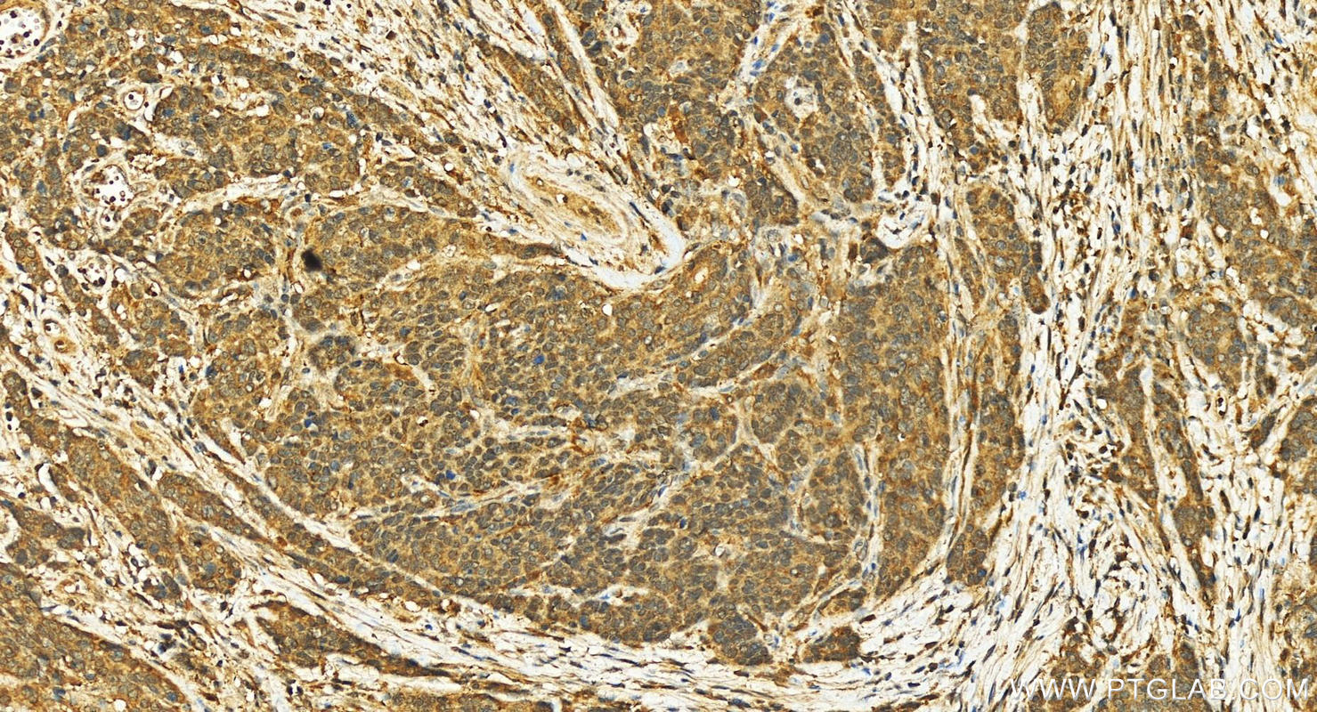 IHC staining of human stomach cancer using 12490-1-AP