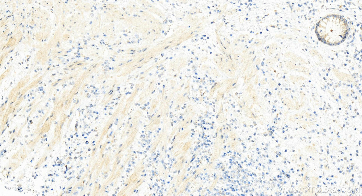 IHC staining of human colon cancer using 15402-1-AP