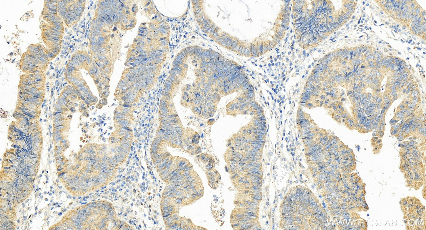 IHC staining of human colon cancer using 15402-1-AP