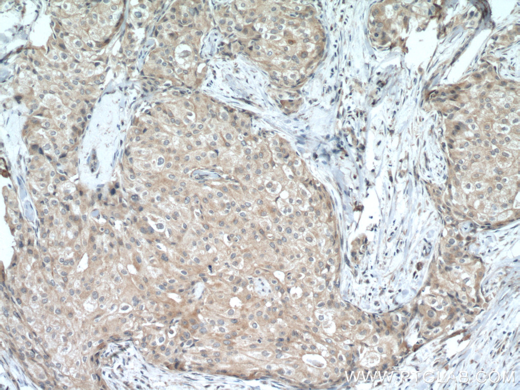 IHC staining of human breast cancer using 18827-1-AP