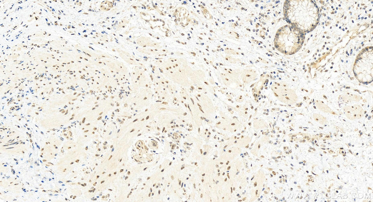 IHC staining of human colon cancer using 24559-1-AP