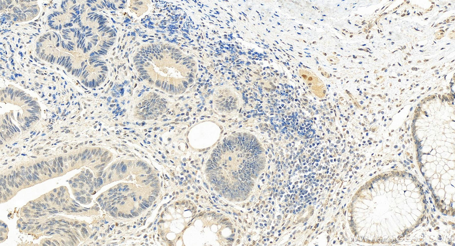 IHC staining of human colon cancer using 24559-1-AP