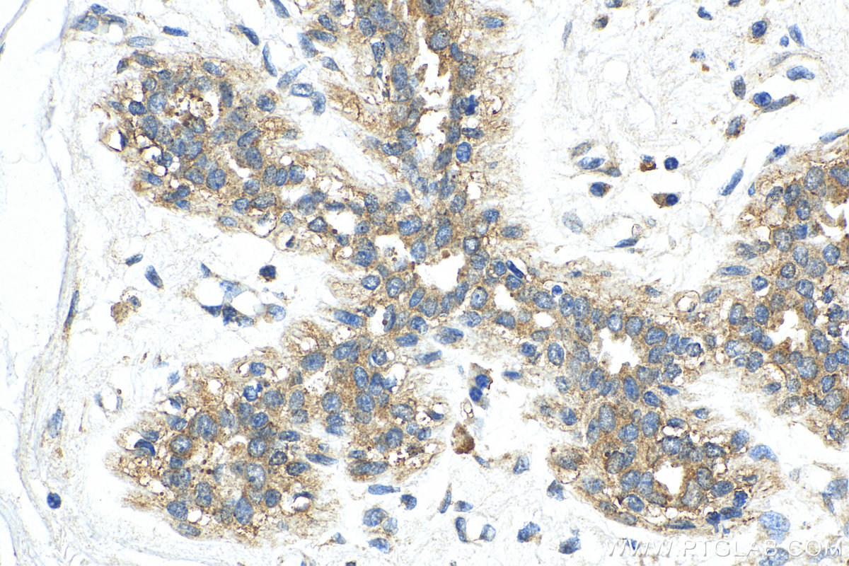 IHC staining of human breast cancer using 18465-1-AP