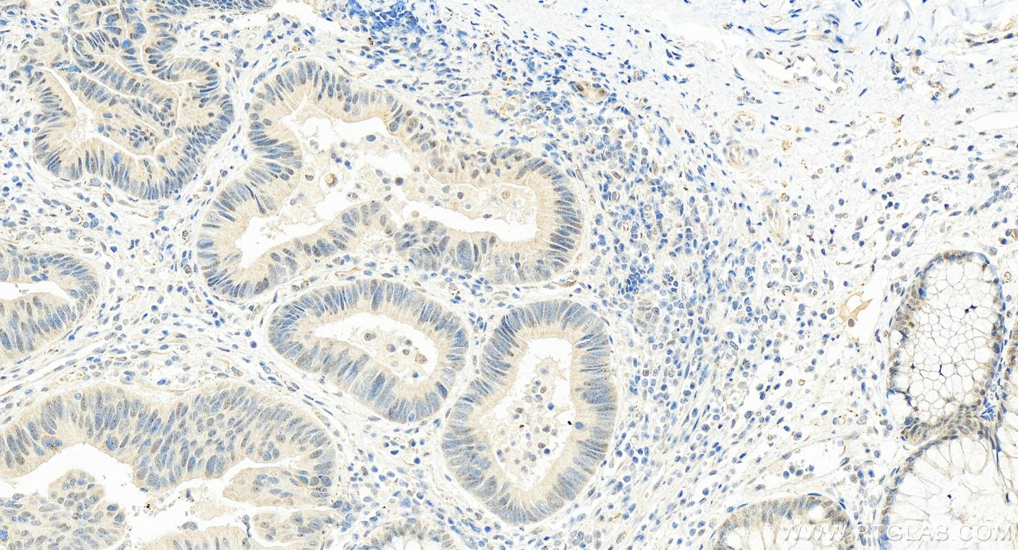 IHC staining of human colon cancer using 23865-1-AP