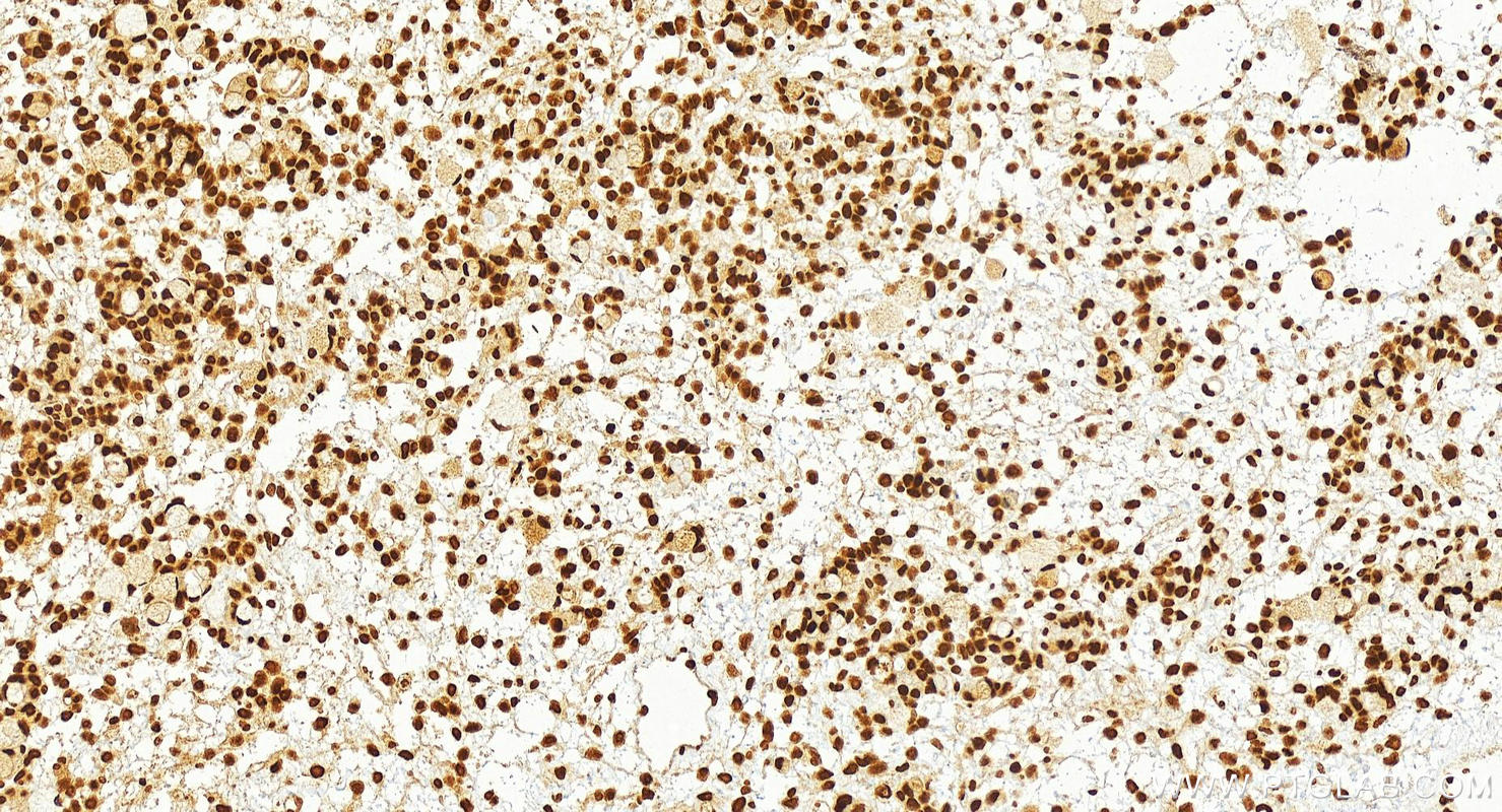 IHC staining of human ovary cancer using 83734-2-RR (same clone as 83734-2-PBS)