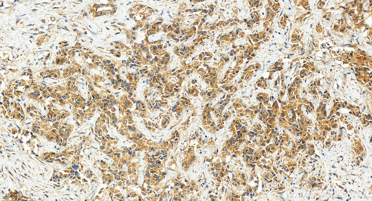 IHC staining of human intrahepatic cholangiocarcinoma using 27217-1-AP