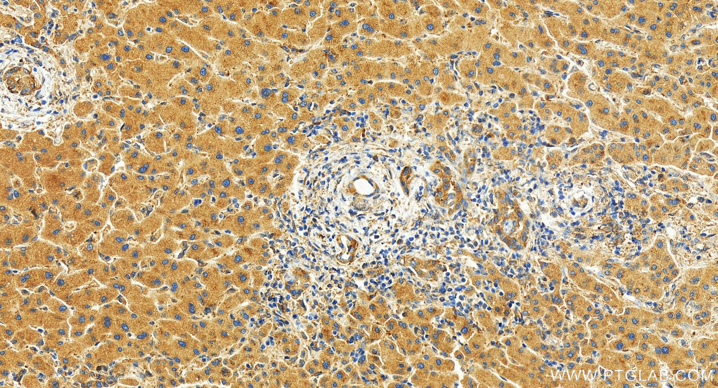 IHC staining of human intrahepatic cholangiocarcinoma using 27217-1-AP