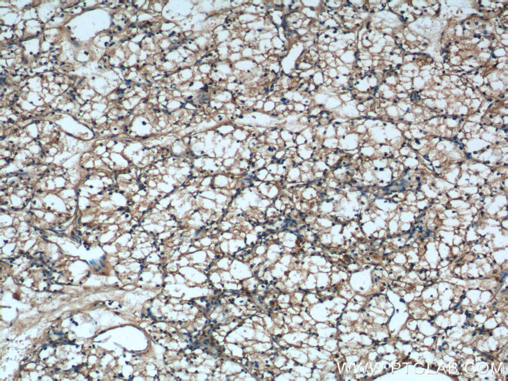 IHC staining of human renal cell carcinoma using 13502-1-AP