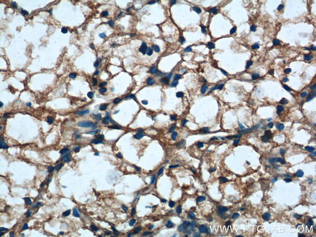 IHC staining of human renal cell carcinoma using 13502-1-AP