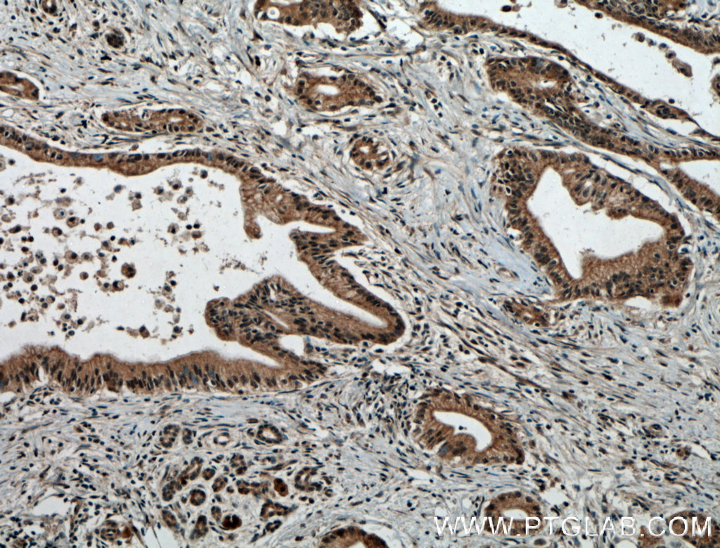 IHC staining of human pancreas cancer using 12076-1-AP