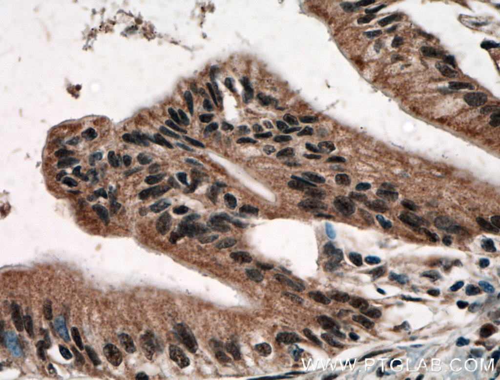 IHC staining of human pancreas cancer using 12076-1-AP