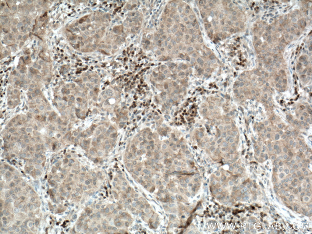 IHC staining of human breast cancer using 18066-1-AP