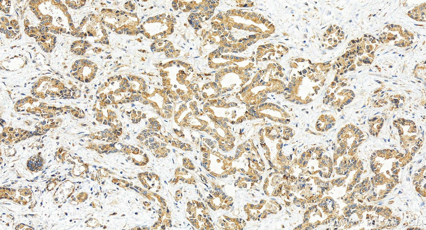 IHC staining of human intrahepatic cholangiocarcinoma using 30440-1-AP