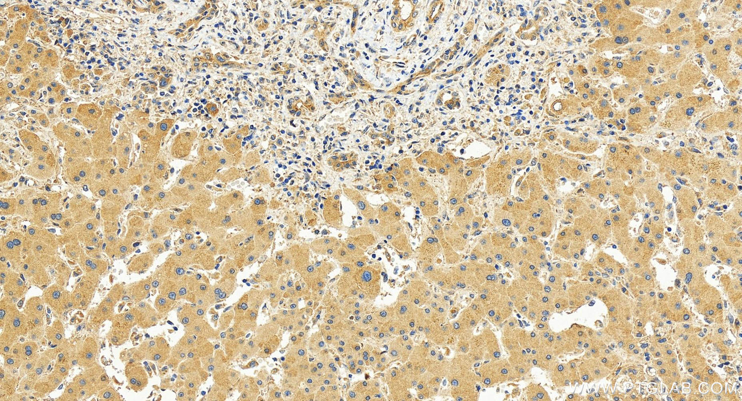 IHC staining of human intrahepatic cholangiocarcinoma using 30440-1-AP