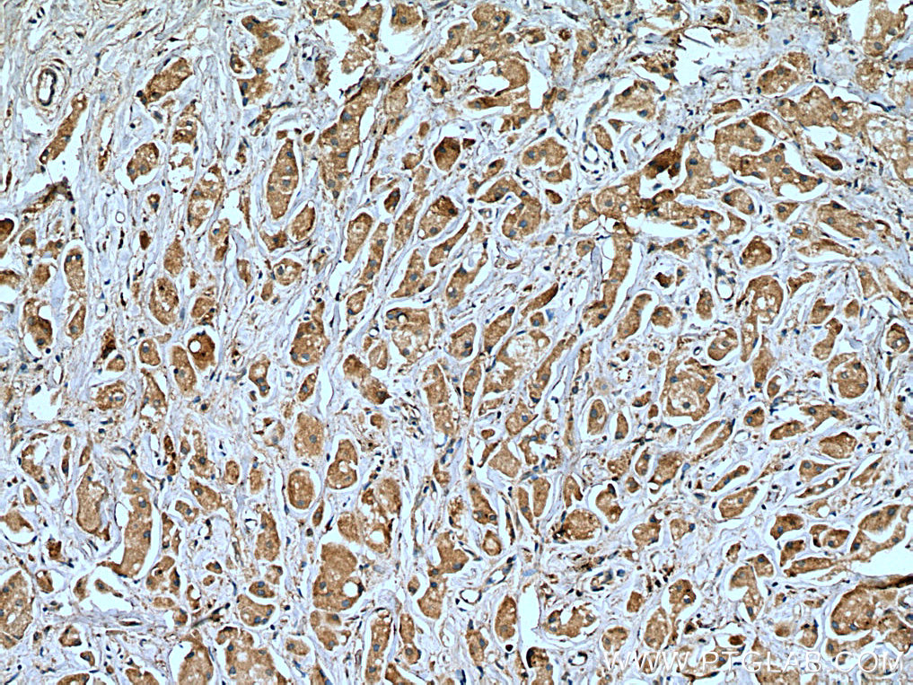 IHC staining of human breast cancer using 67321-1-Ig (same clone as 67321-1-PBS)