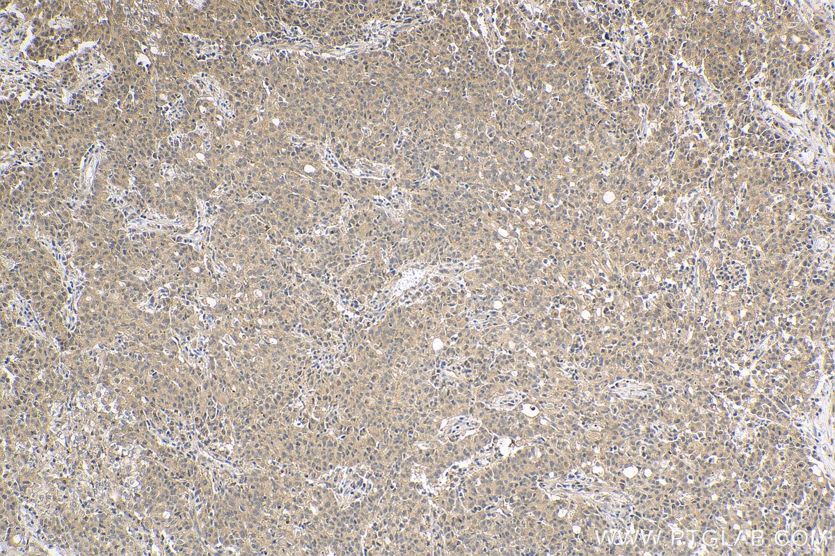 IHC staining of human stomach cancer using 13303-1-AP