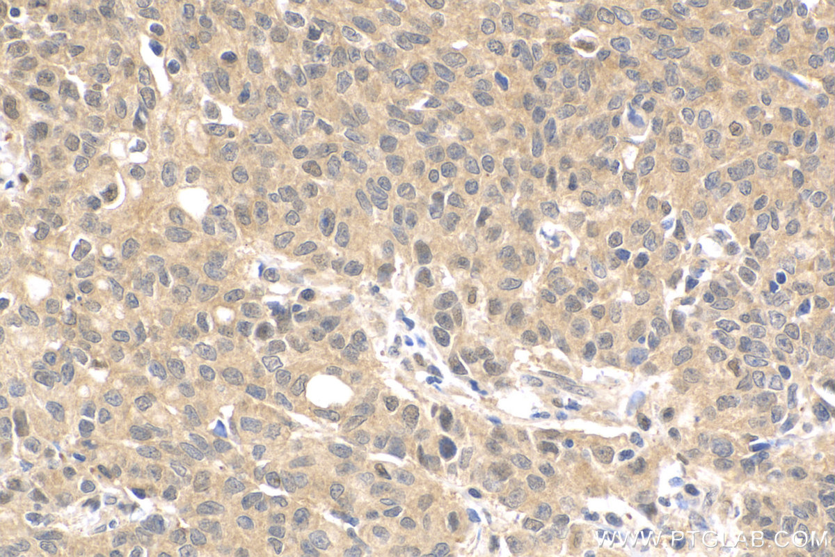 IHC staining of human stomach cancer using 13303-1-AP