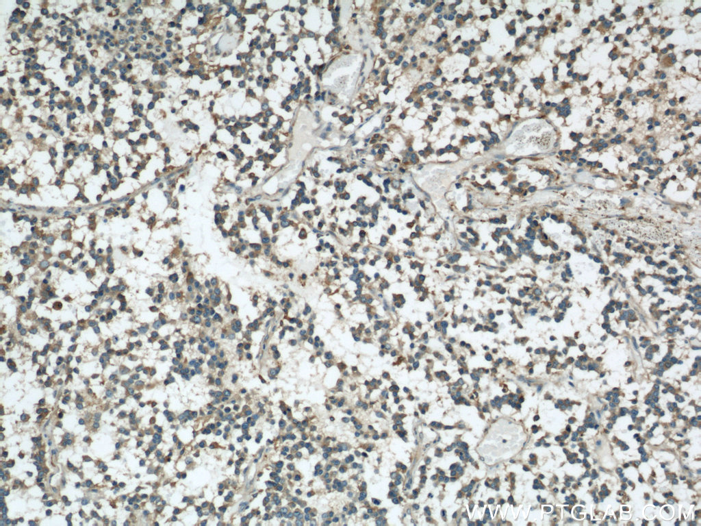 IHC staining of human gliomas using 22016-1-AP