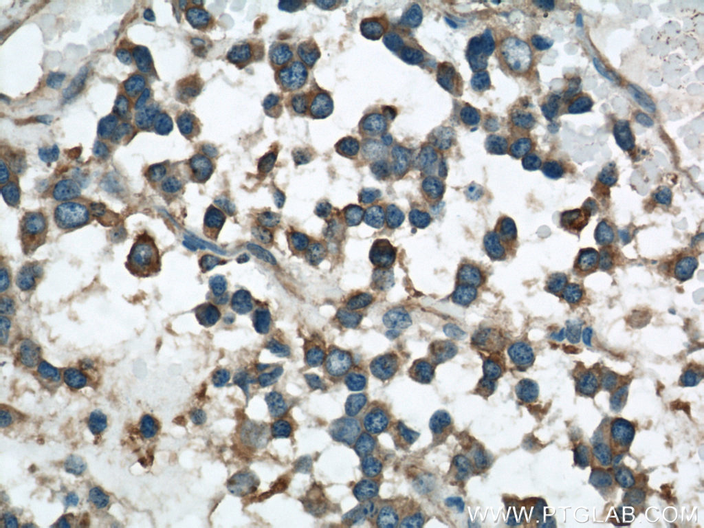 IHC staining of human gliomas using 22016-1-AP