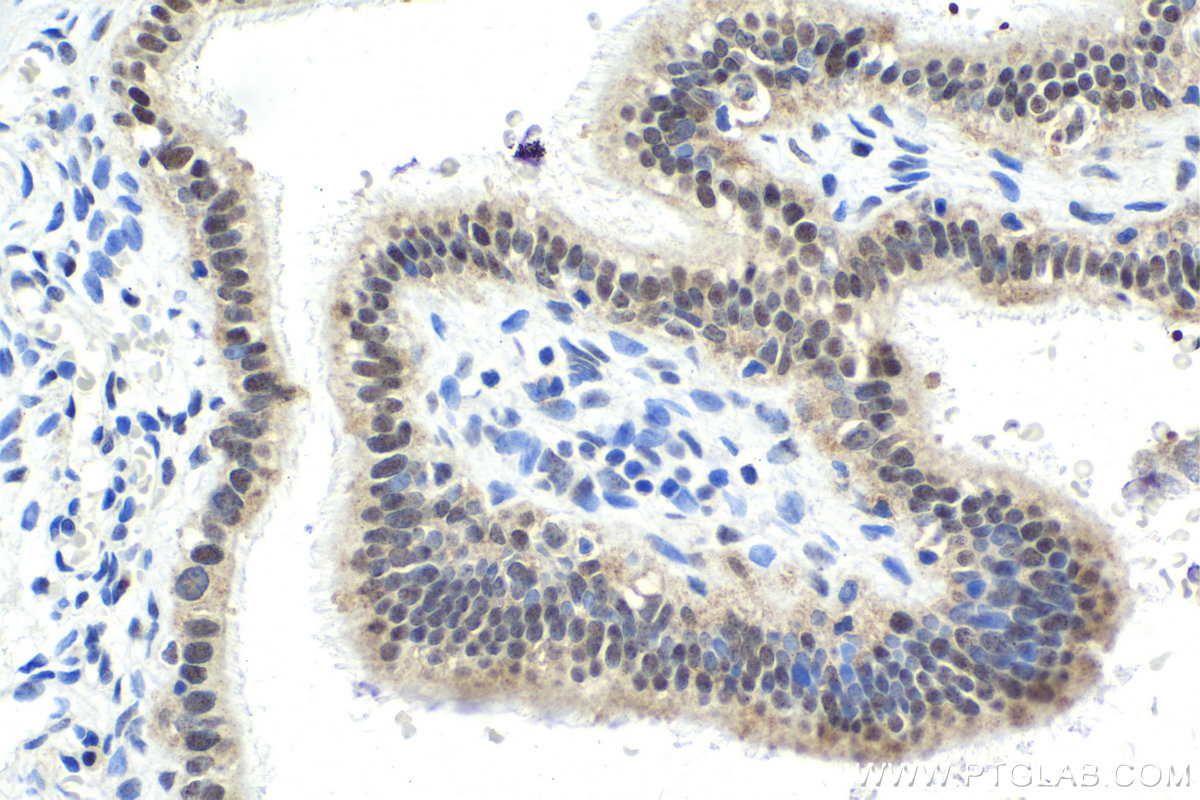 IHC staining of human ovary tumor using 15773-1-AP