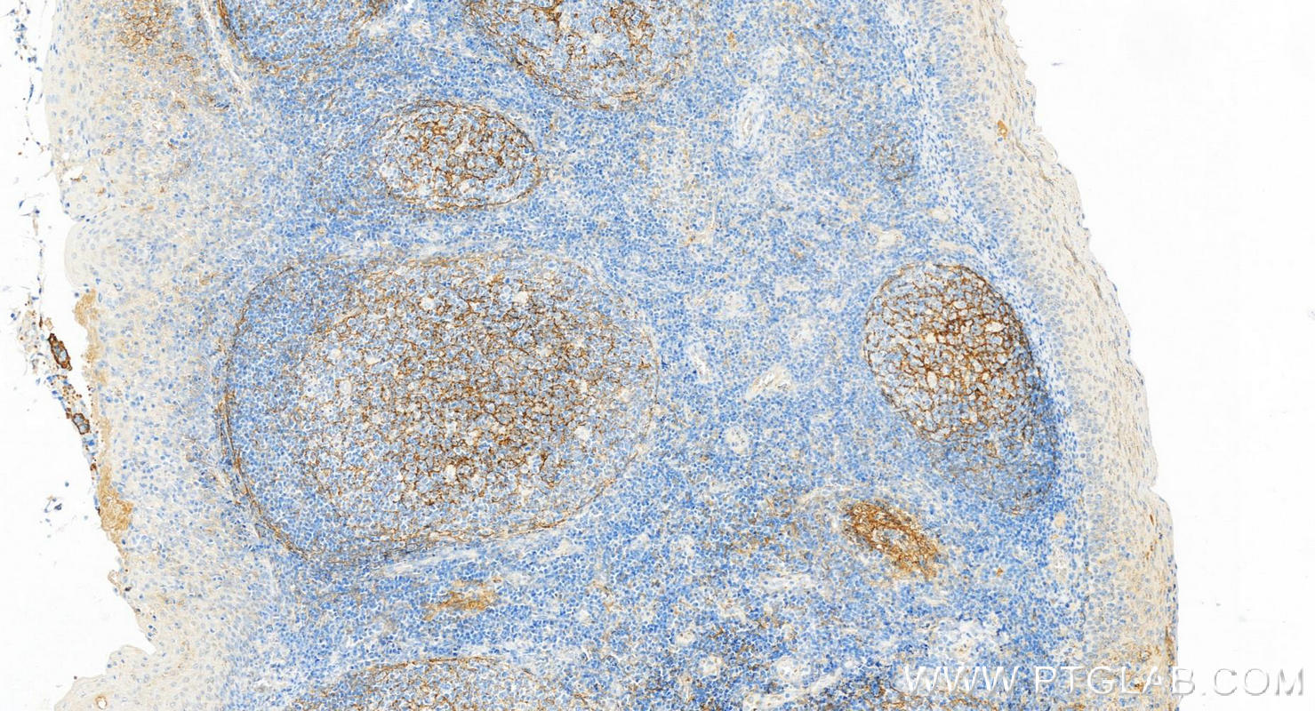 IHC staining of human tonsillitis using 66294-1-Ig (same clone as 66294-1-PBS)