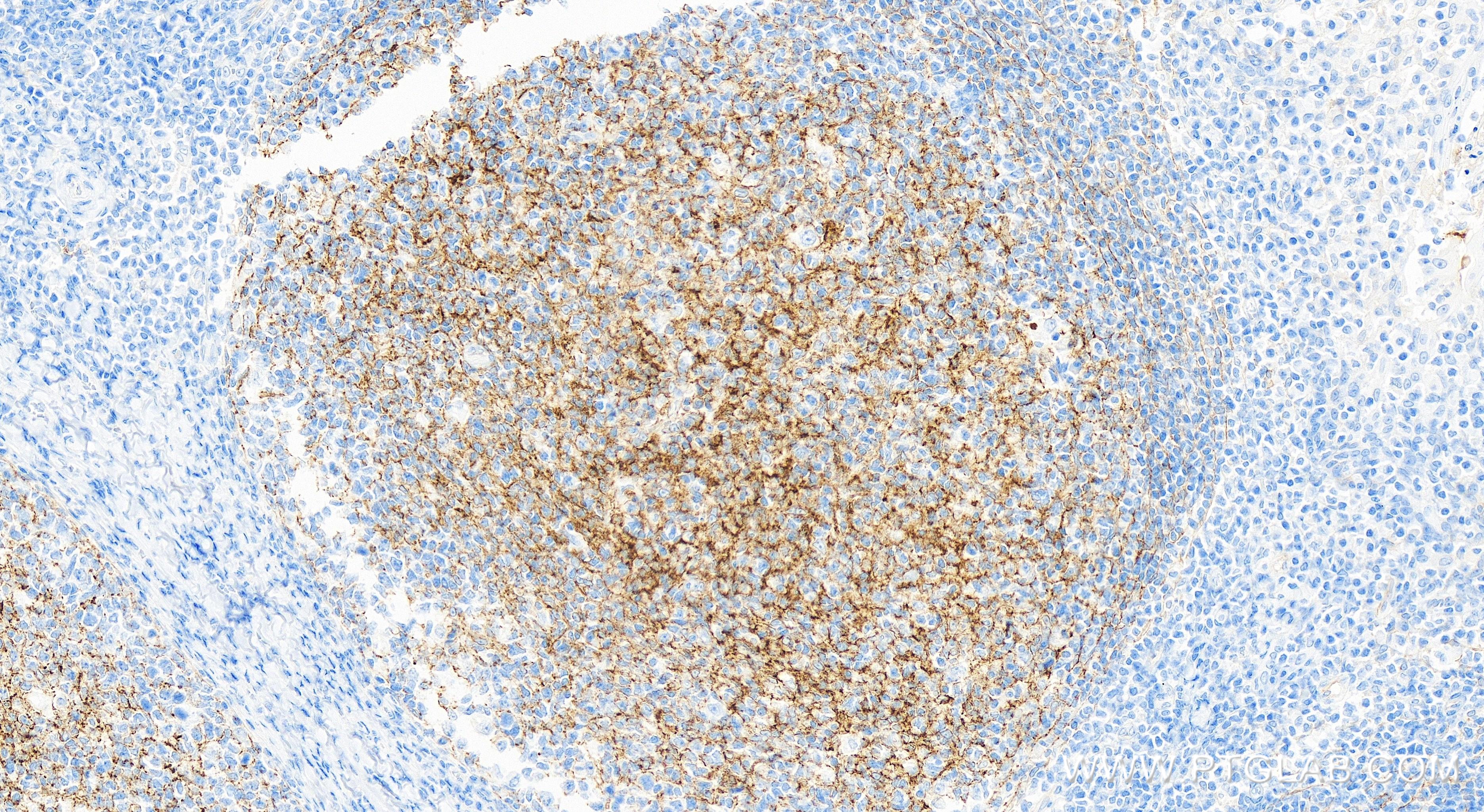 IHC staining of human tonsillitis using 84249-4-RR