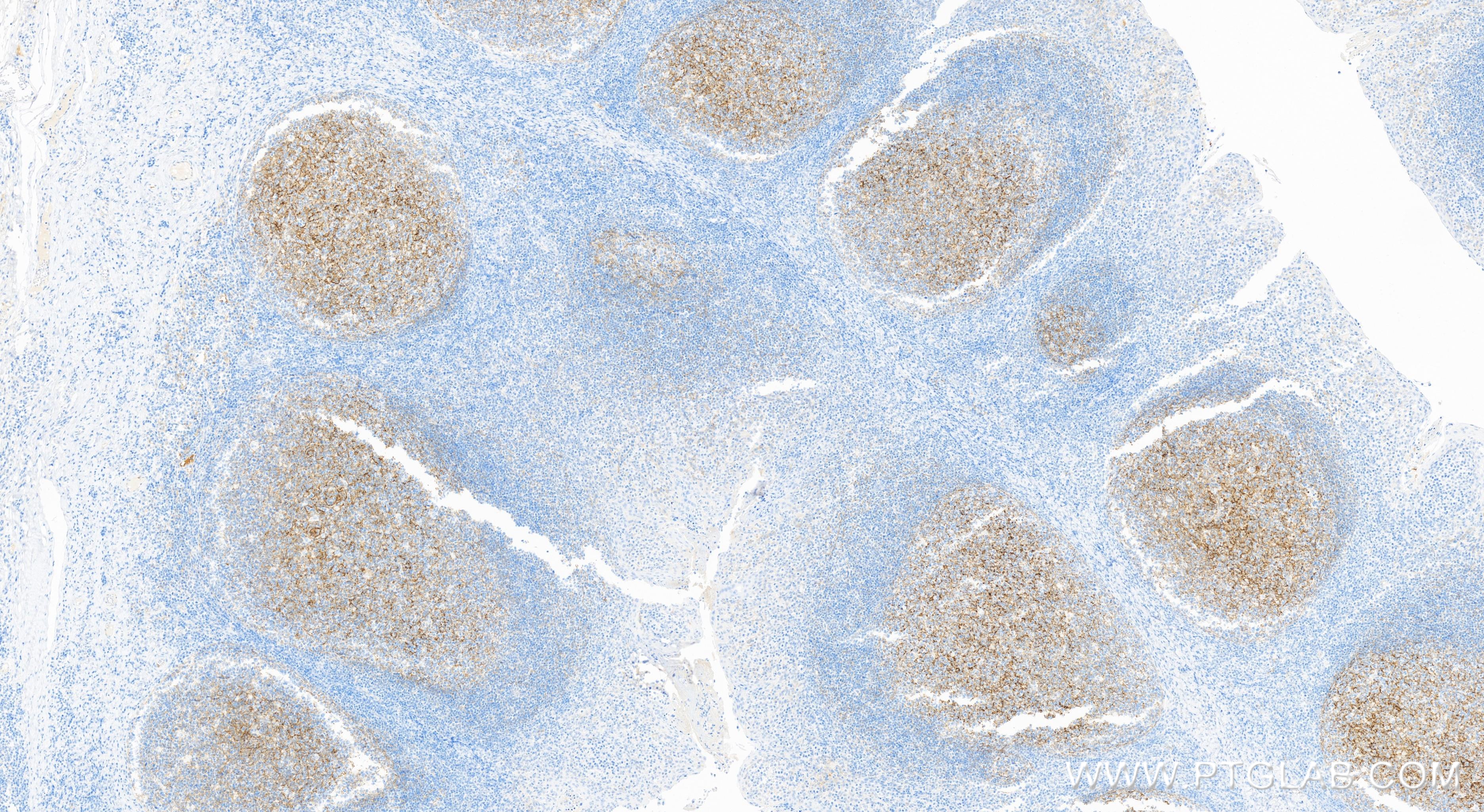 IHC staining of human tonsillitis using 84249-4-RR