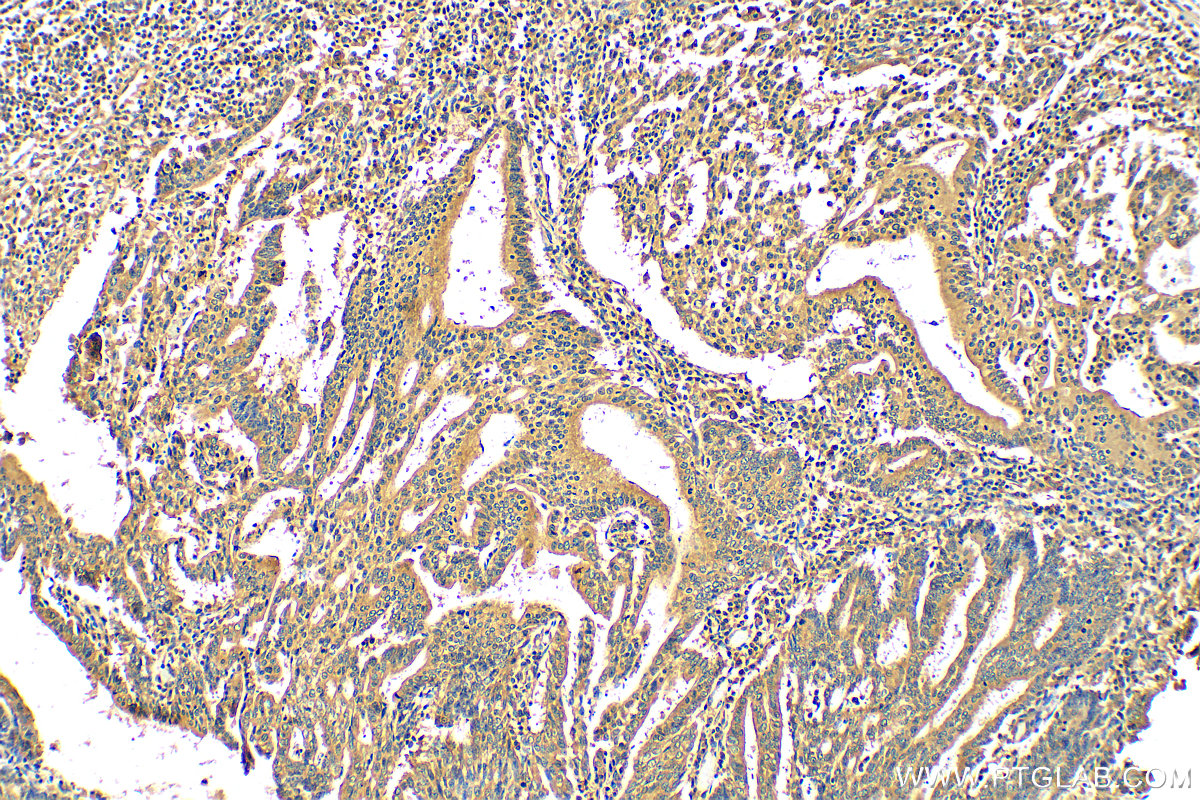 IHC staining of human endometrial cancer using 30599-1-AP (same clone as 30599-1-PBS)