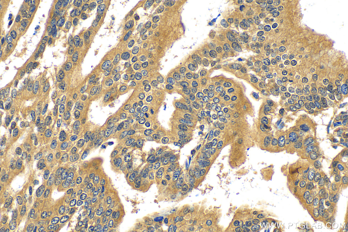 IHC staining of human endometrial cancer using 30599-1-AP (same clone as 30599-1-PBS)