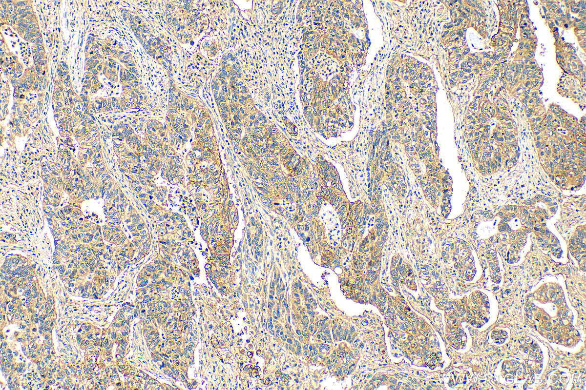 IHC staining of human stomach cancer using 30599-1-AP (same clone as 30599-1-PBS)