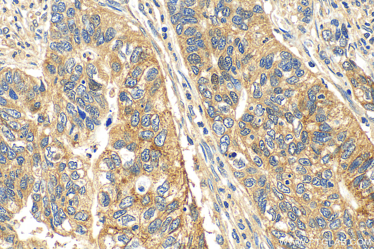 IHC staining of human stomach cancer using 30599-1-AP (same clone as 30599-1-PBS)