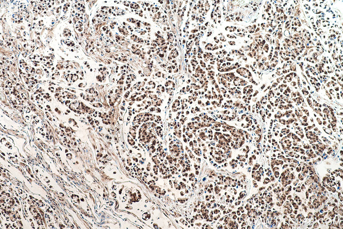 IHC staining of human colon cancer using 60316-1-Ig